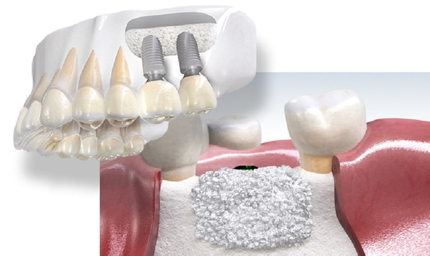 Đề tài “Tăng thể tích xương & Đặt Implant đồng thời”